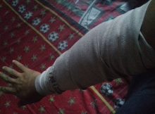 tennis elbow